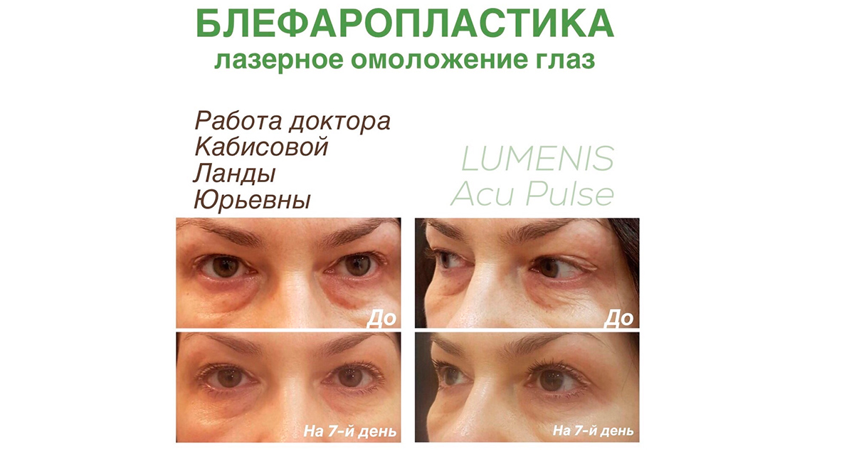 Неабляционного омоложения лица отзывы Неабляционного омоложения лица отзывы