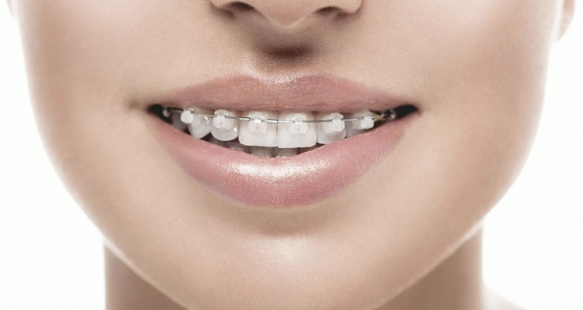 Все в ряд: выбираем брекеты